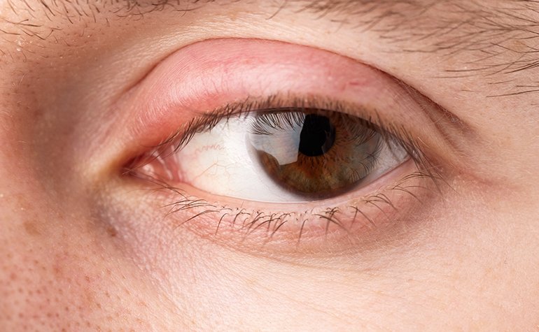 Nahaufnahme eines Auges mit einer Schwellung am oberen Augenlid